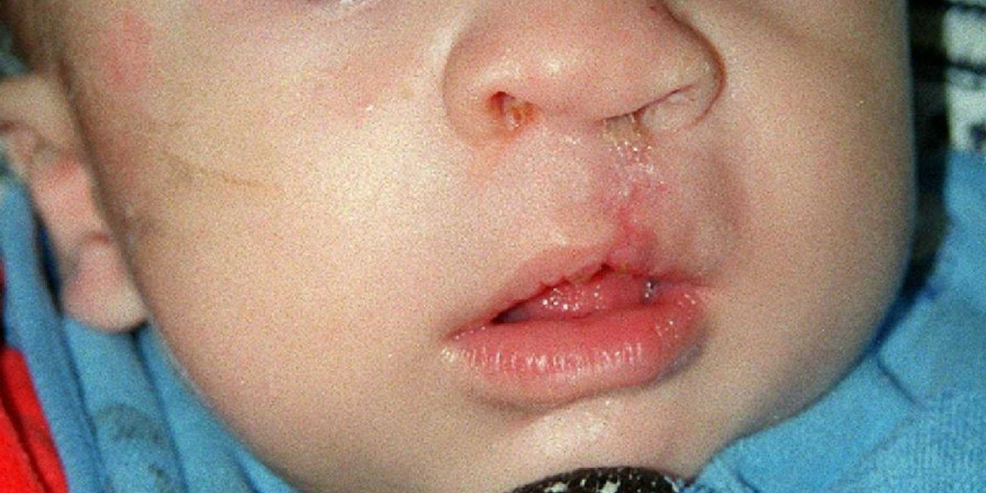 Die „Hasenscharte“ gehört zu den häufigsten angeborenen Fehlbildungen, die heute jedoch operativ beseitigt werden können. Das Foto zeigt ein bereits operiertes Kind.