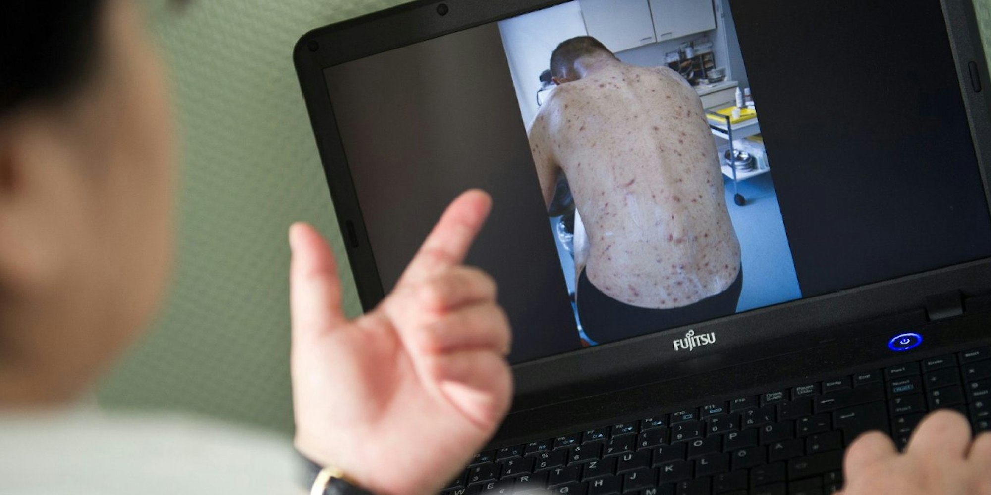 Obdachlosen-Ärztin Jenny De la Torre zeigt auf ihrem Laptop ein Foto von einem Patienten, der von Krätze befallen ist.